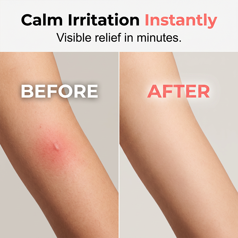 Arrêtez de vous gratter en 10 secondes ! Stylo anti-démangeaisons portable – Impulsion thermique, sans crème, sans dégâts
